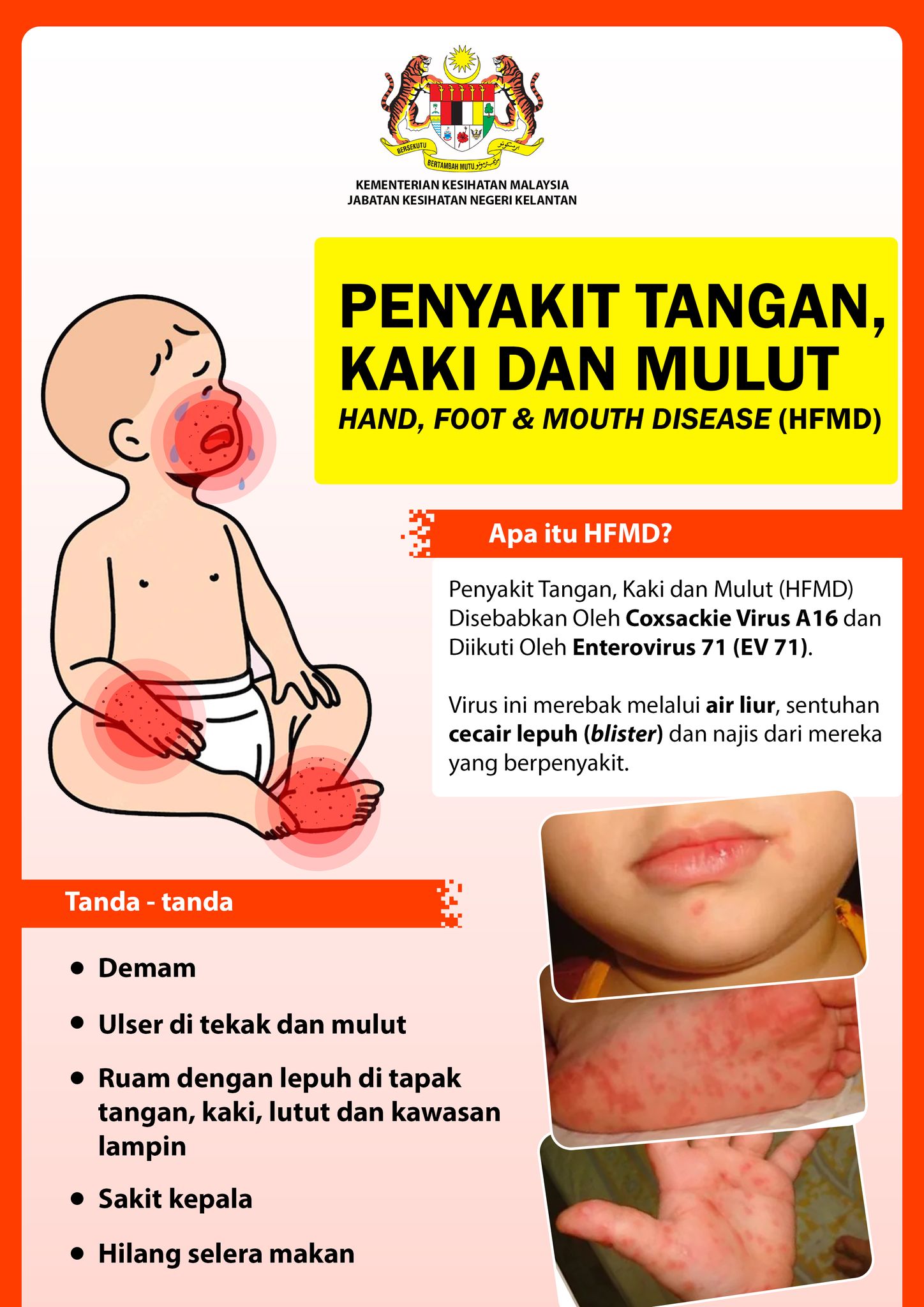 hfmd